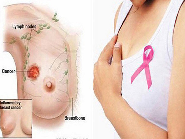 Thực phẩm dễ gây ung thư vú ở chị em cần hạn chế